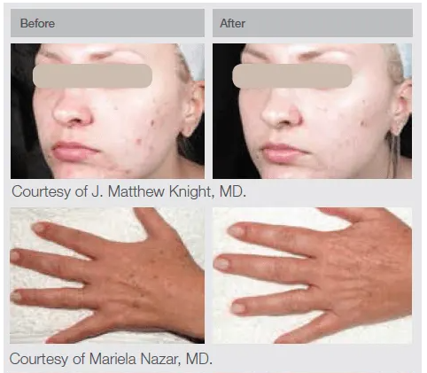 Lumenis IPL Before and After