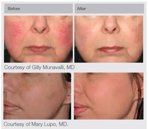 Lumenis IPL Before and After