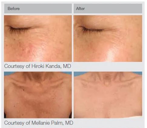 Lumenis IPL Before and After