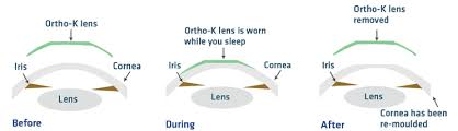 Orthokeratology & Myopia Control