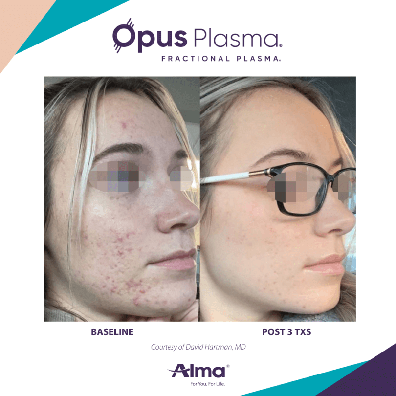Opus Plasma Before & After