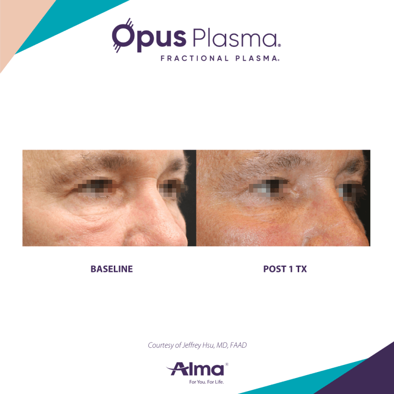 Opus Plasma Before & After