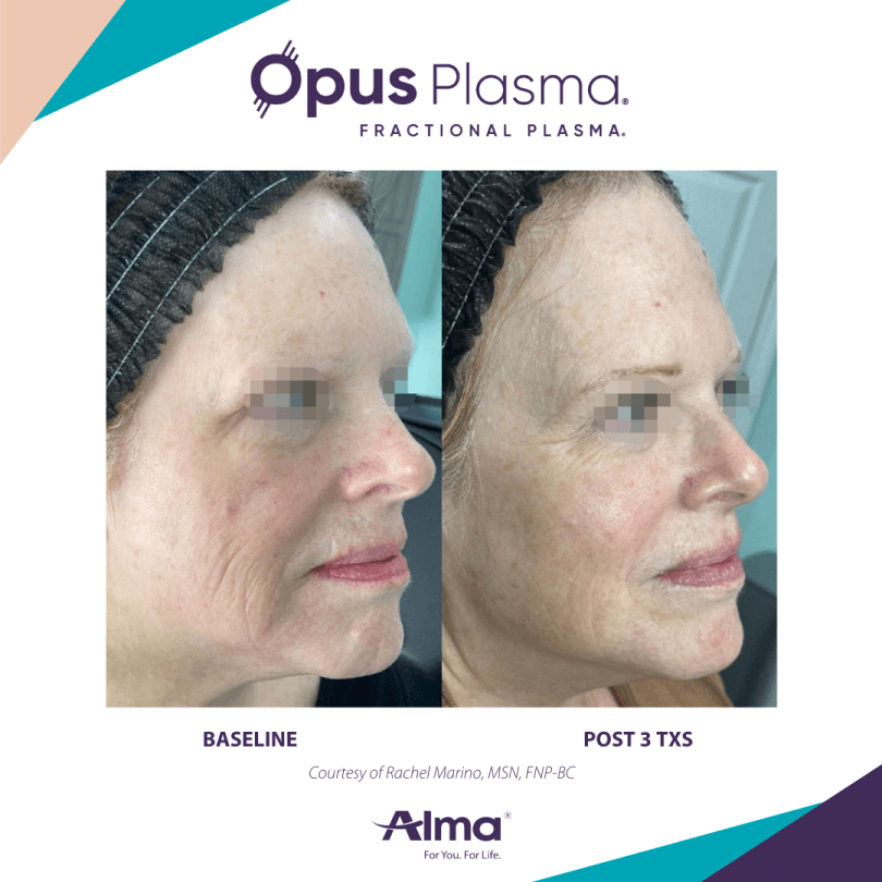 Opus Plasma Before & After