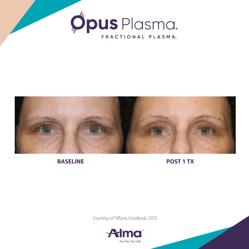 Opus Plasma Before & After